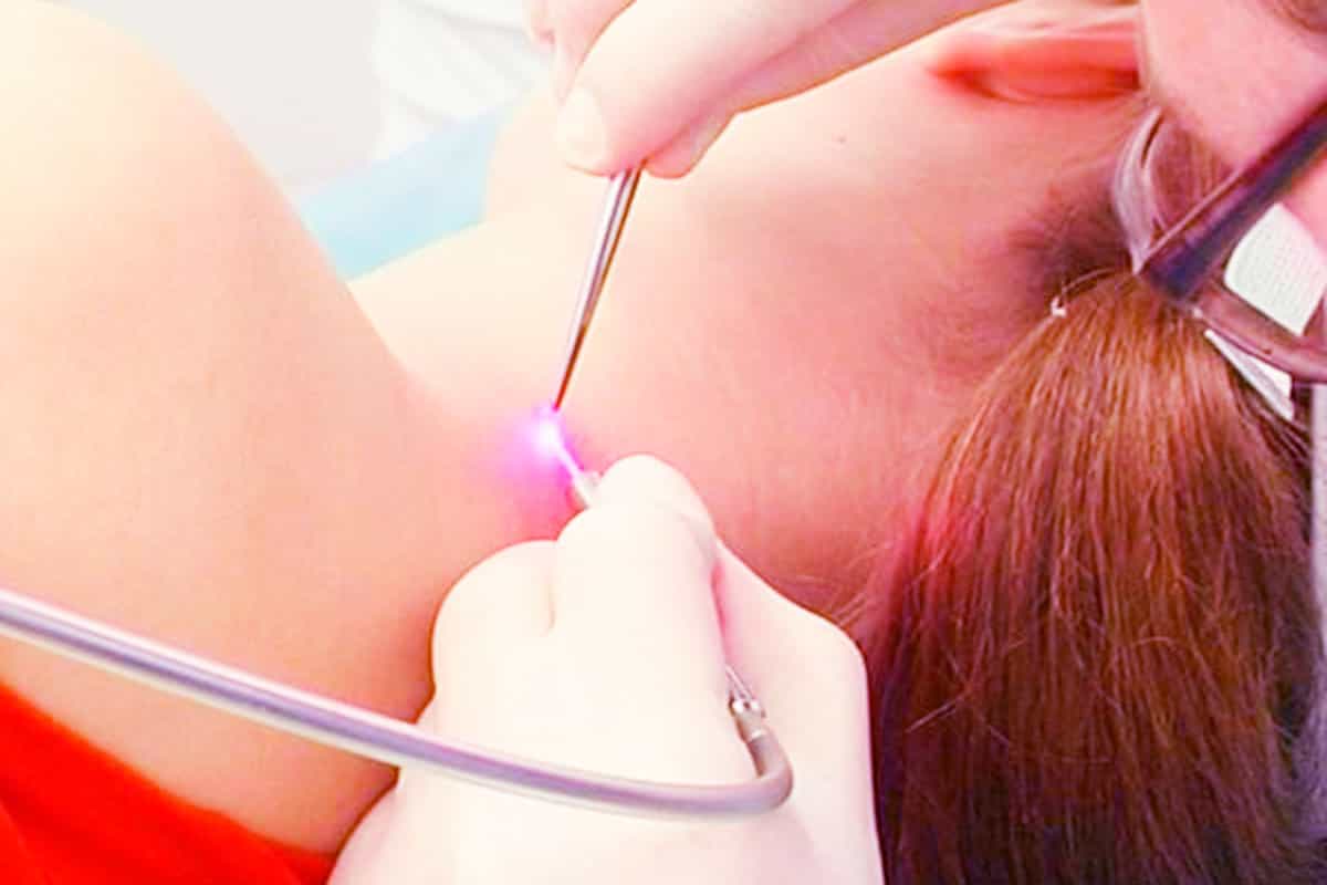 Лазерное удаление новообразований кожи